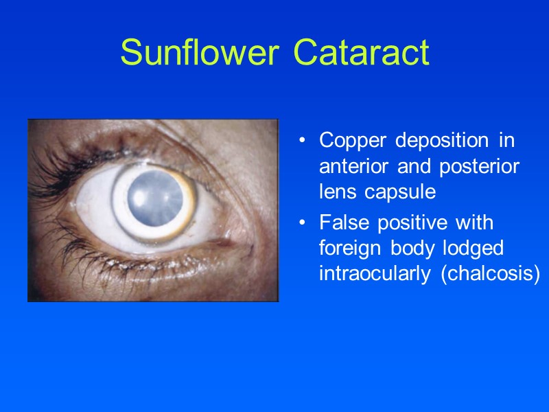 Sunflower Cataract Copper deposition in anterior and posterior lens capsule False positive with foreign